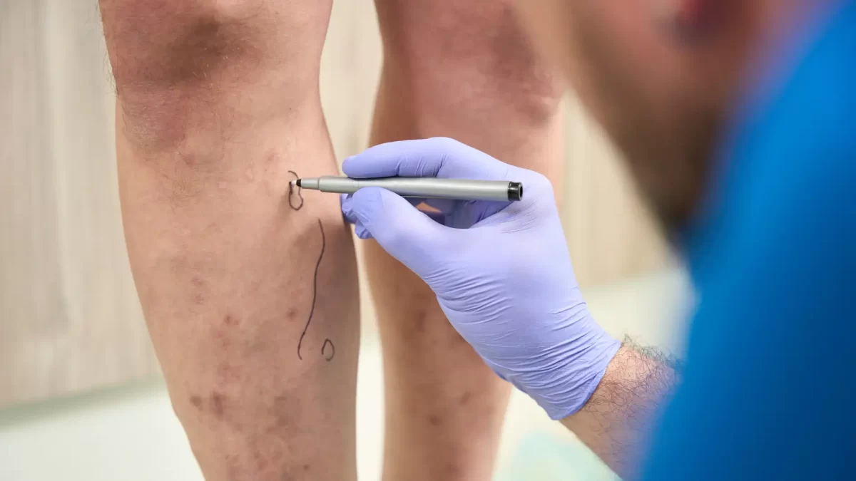 Who Is at Risk of Getting Varicose Veins and How Can They Treat Them Who Is at Risk of Getting Varicose Veins and How Can They Treat Them?