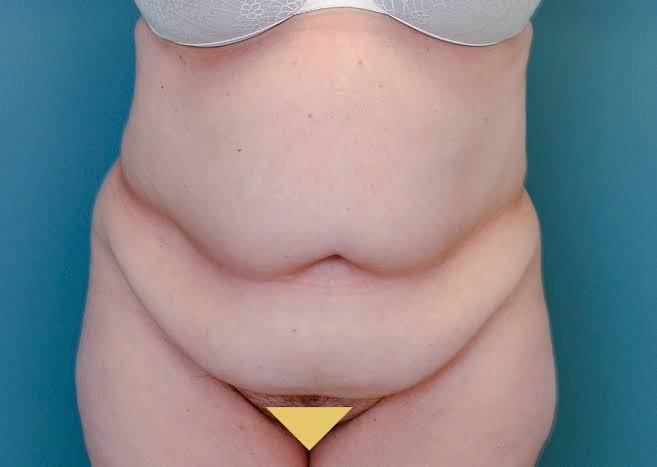 How Tummy Tuck Surgery Can Transform Your Contour How Tummy Tuck Surgery Can Transform Your Contour