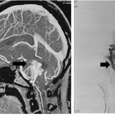 Neuroradiology’s Impact on Surgical Outcomes in Brain Surgery Neuroradiology's Impact on Surgical Outcomes in Brain Surgery