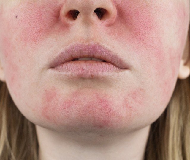 Understanding the Role of a Dermatologist in Treating Rosacea
