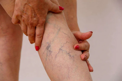 When To Get Help With Varicose Veins When To Get Help With Varicose Veins